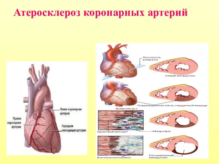 Атеросклероз коронарных артерий