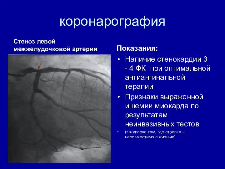 коронарография Стеноз левой межжелудочковой артерии Показания: Наличие стенокардии 3 - 4 ФК при