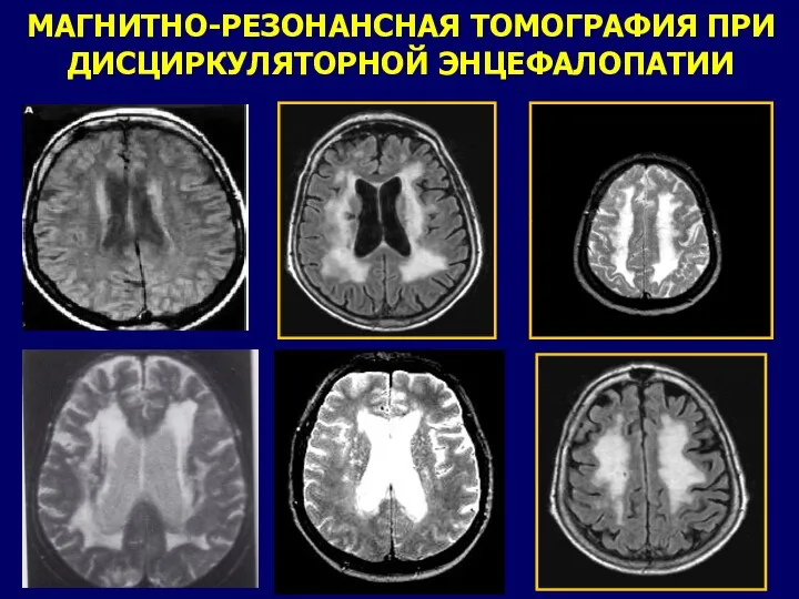 МАГНИТНО-РЕЗОНАНСНАЯ ТОМОГРАФИЯ ПРИ ДИСЦИРКУЛЯТОРНОЙ ЭНЦЕФАЛОПАТИИ