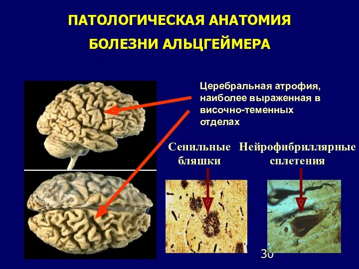 ПАТОЛОГИЧЕСКАЯ АНАТОМИЯ БОЛЕЗНИ АЛЬЦГЕЙМЕРА Церебральная атрофия, наиболее выраженная в височно-теменных отделах Сенильные бляшки Нейрофибриллярные сплетения