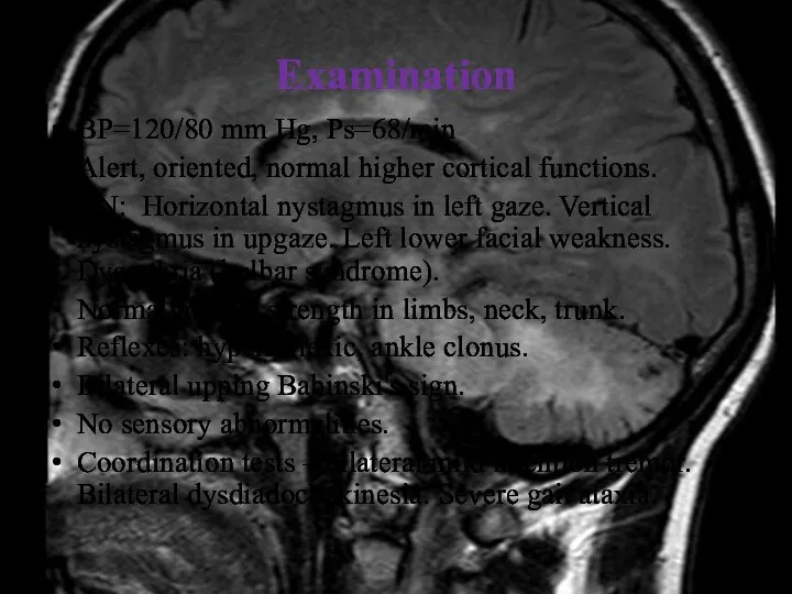 Examination BP=120/80 mm Hg, Ps=68/min Alert, oriented, normal higher cortical functions. CN: Horizontal