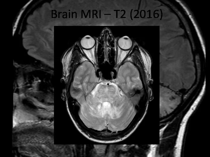 Brain MRI – T2 (2016)