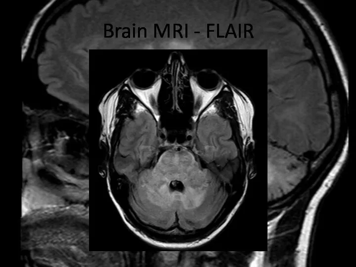 Brain MRI - FLAIR