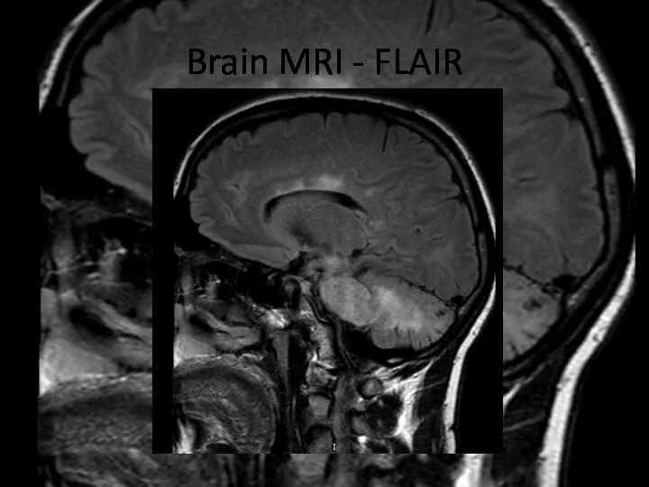 Brain MRI - FLAIR