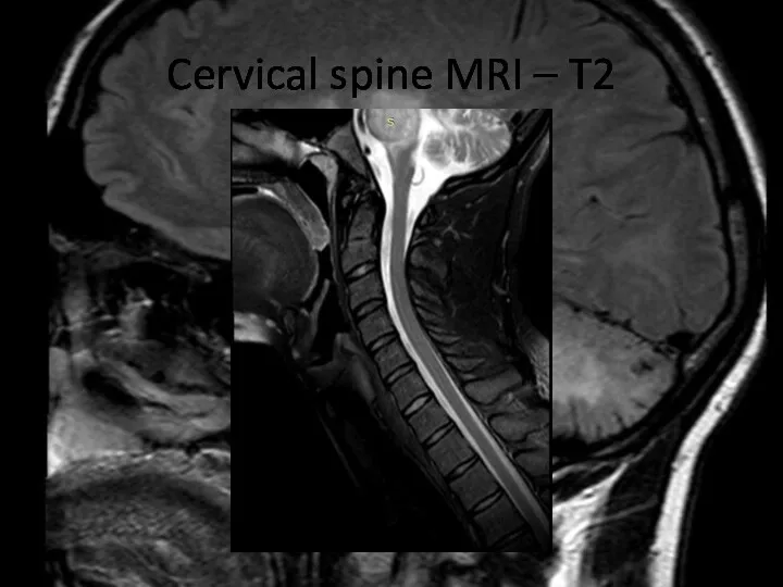 Cervical spine MRI – T2