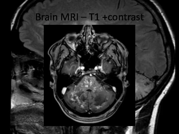 Brain MRI – T1 +contrast