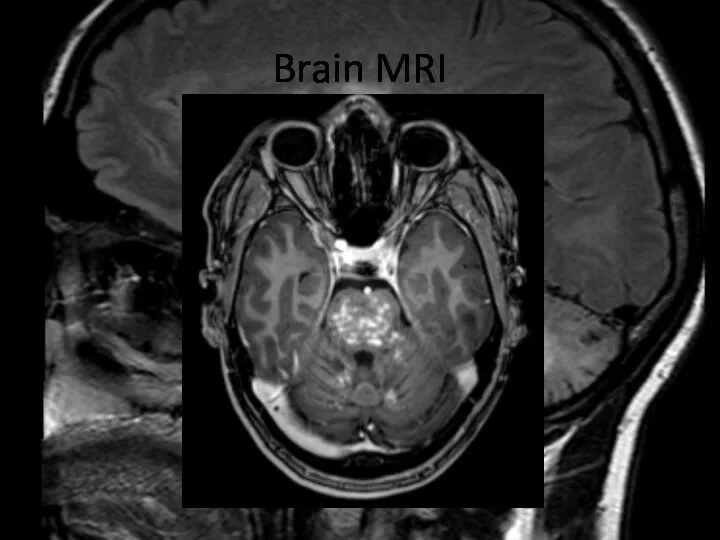 Brain MRI