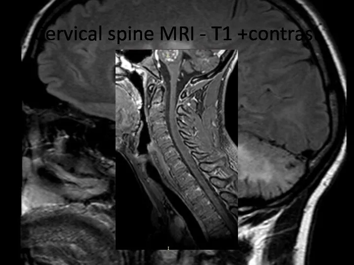 Cervical spine MRI - T1 +contrast