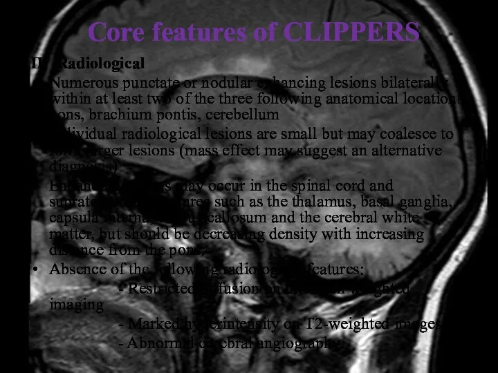 Core features of CLIPPERS II. Radiological Numerous punctate or nodular enhancing lesions bilaterally