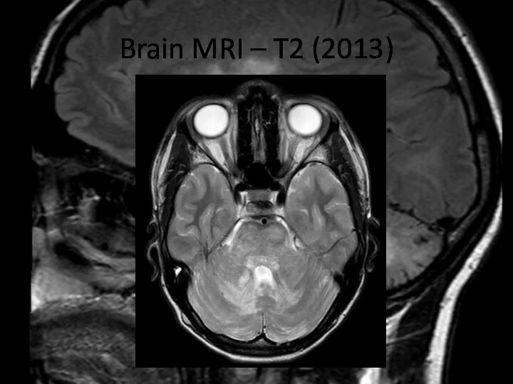 Brain MRI – T2 (2013)