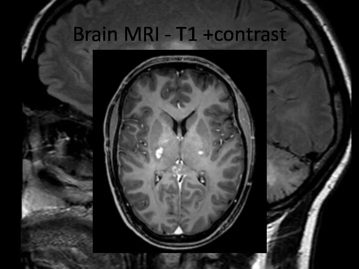 Brain MRI - T1 +contrast