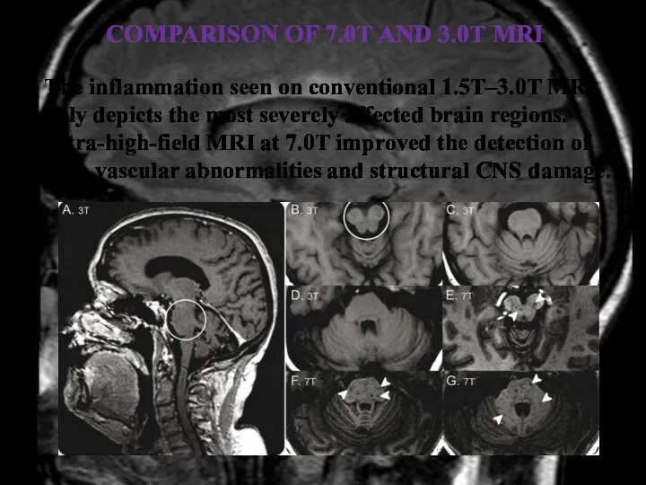 COMPARISON OF 7.0T AND 3.0T MRI The inflammation seen on conventional 1.5T–3.0T MRI