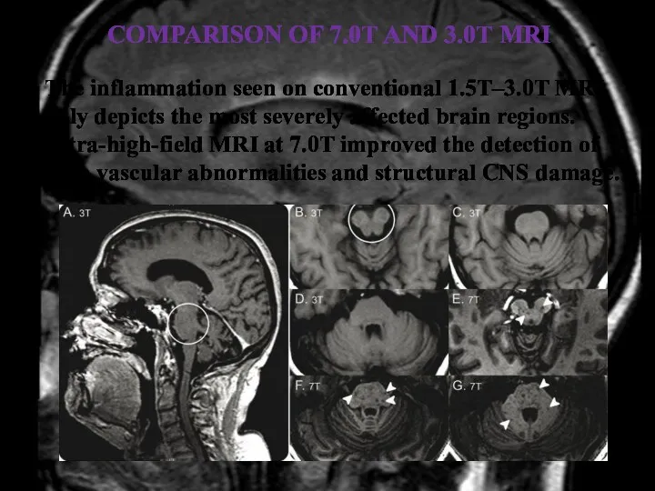 COMPARISON OF 7.0T AND 3.0T MRI The inflammation seen on