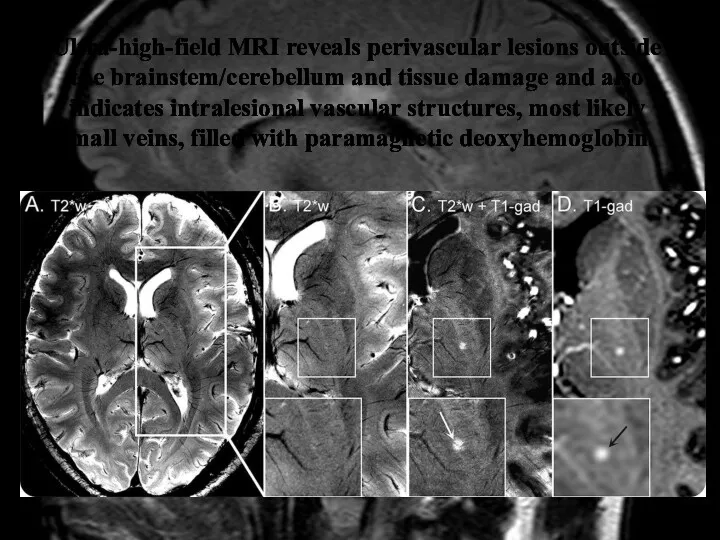Ultra-high-field MRI reveals perivascular lesions outside the brainstem/cerebellum and tissue damage and also