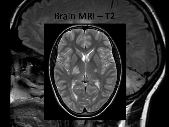 Brain MRI – T2