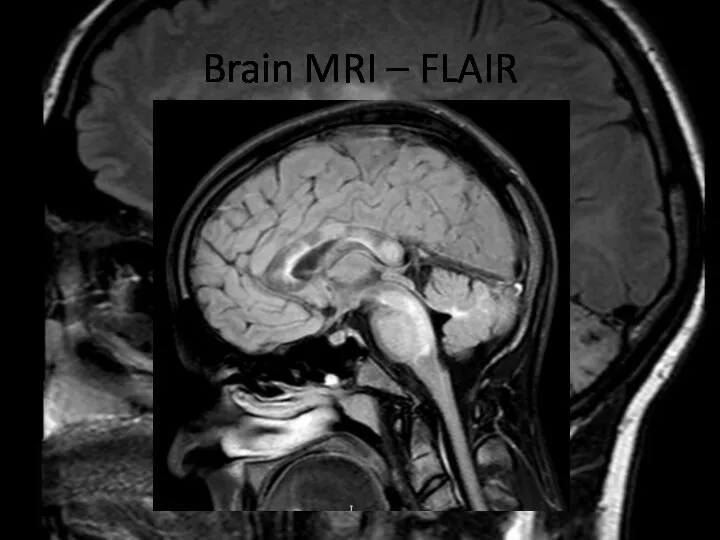 Brain MRI – FLAIR