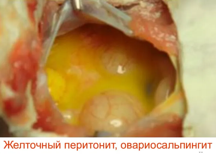 Желточный перитонит, овариосальпингит
