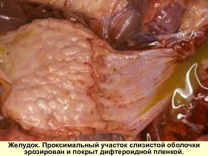 Желудок. Проксимальный участок слизистой оболочки эрозирован и покрыт дифтероидной пленкой.