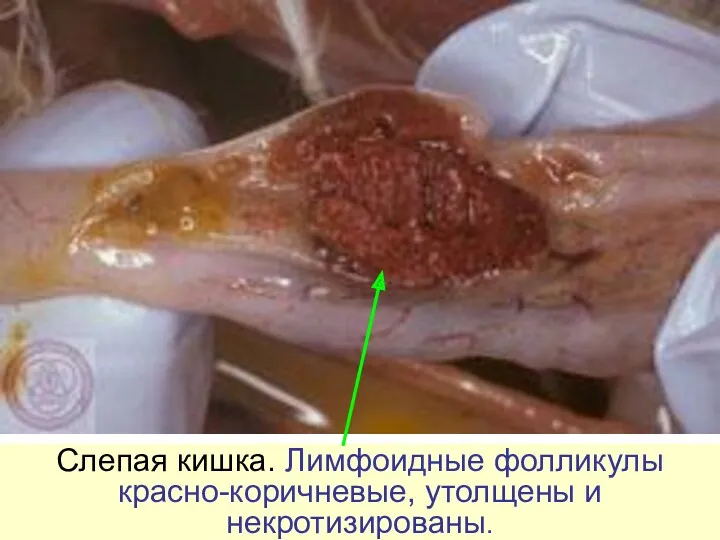 Слепая кишка. Лимфоидные фолликулы красно-коричневые, утолщены и некротизированы.