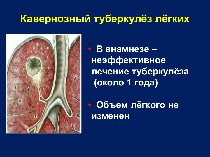 Кавернозный туберкулёз лёгких В анамнезе – неэффективное лечение туберкулёза (около 1 года) Объем лёгкого не изменен