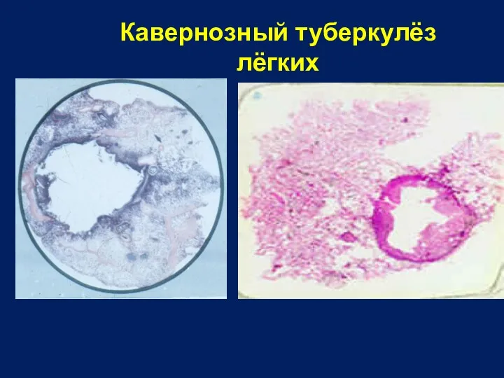 Кавернозный туберкулёз лёгких