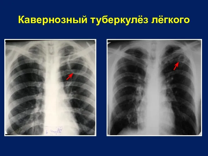 Кавернозный туберкулёз лёгкого