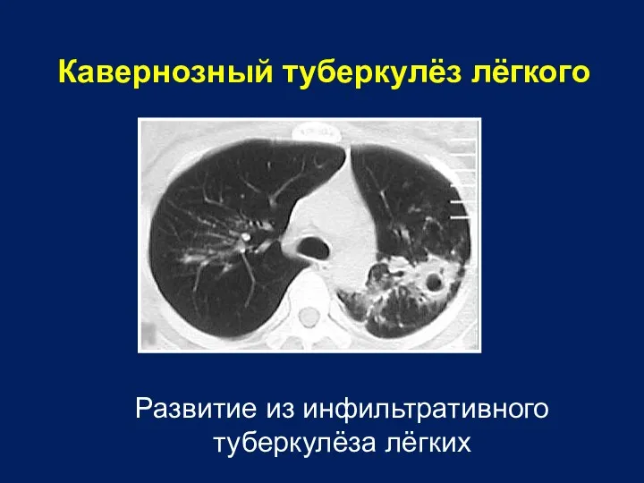 Кавернозный туберкулёз лёгкого Развитие из инфильтративного туберкулёза лёгких