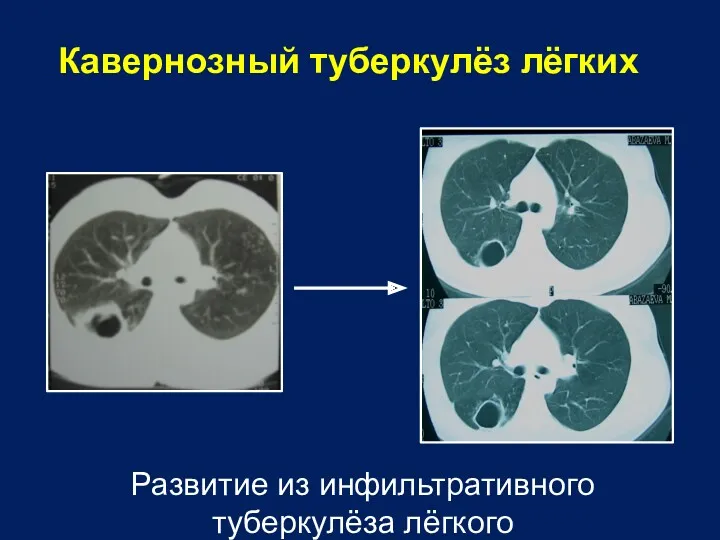 Кавернозный туберкулёз лёгких Развитие из инфильтративного туберкулёза лёгкого