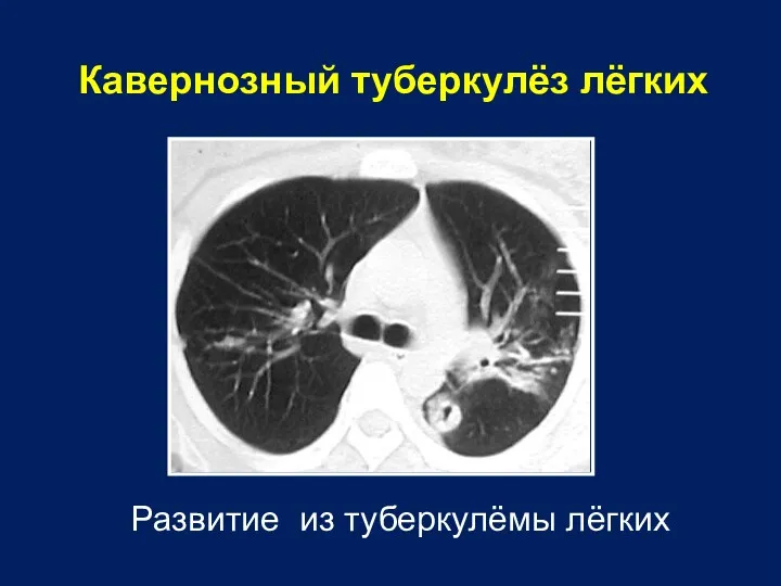 Кавернозный туберкулёз лёгких Развитие из туберкулёмы лёгких