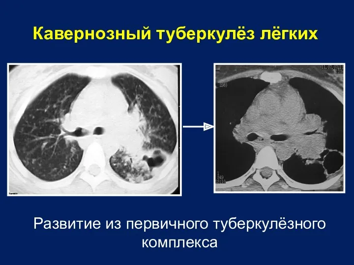 Кавернозный туберкулёз лёгких Развитие из первичного туберкулёзного комплекса