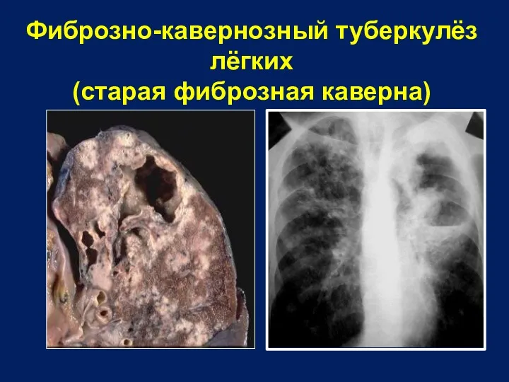 Фиброзно-кавернозный туберкулёз лёгких (старая фиброзная каверна)