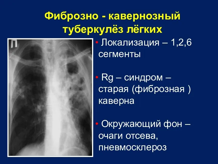 Фиброзно - кавернозный туберкулёз лёгких Локализация – 1,2,6 сегменты Rg – синдром –