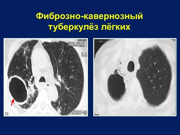 Фиброзно-кавернозный туберкулёз лёгких