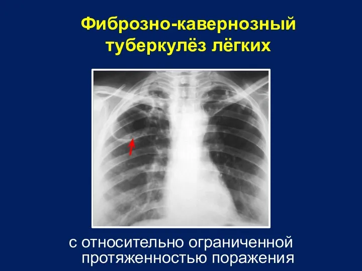 Фиброзно-кавернозный туберкулёз лёгких с относительно ограниченной протяженностью поражения