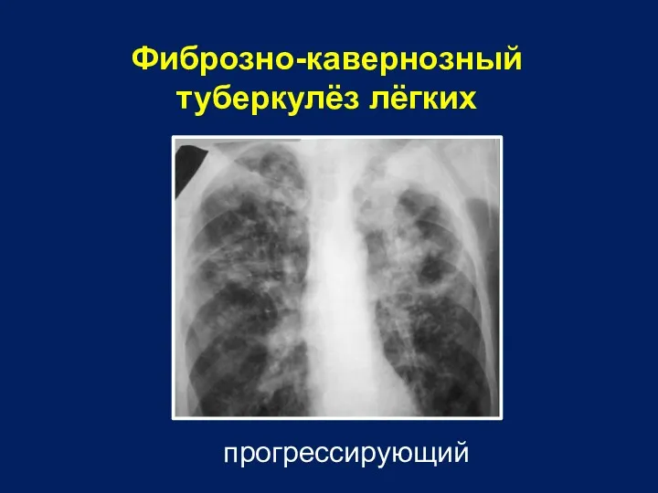 Фиброзно-кавернозный туберкулёз лёгких прогрессирующий