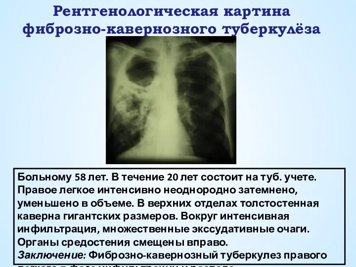 Рентгенологическая картина фиброзно-кавернозного туберкулёза Больному 58 лет. В течение 20