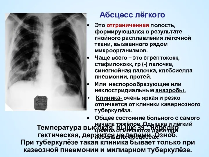 Абсцесс лёгкого Это отграниченная полость, формирующаяся в результате гнойного расплавления