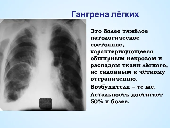 Гангрена лёгких Это более тяжёлое патологическое состояние, характеризующееся обширным некрозом