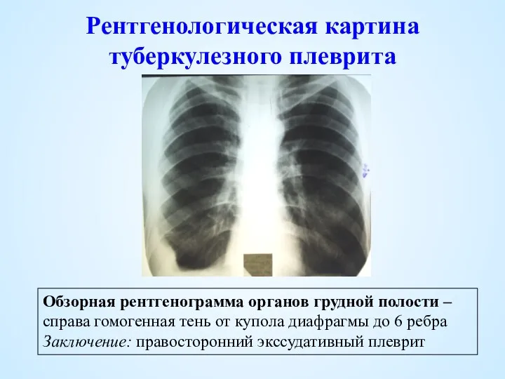 Рентгенологическая картина туберкулезного плеврита Обзорная рентгенограмма органов грудной полости –