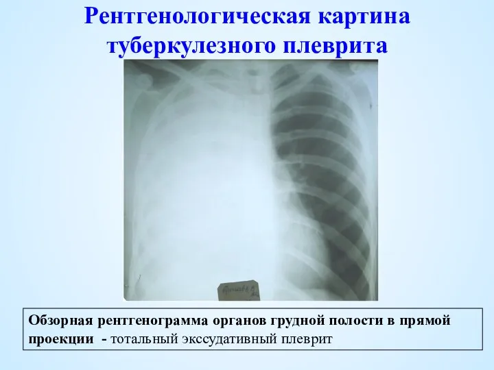 Рентгенологическая картина туберкулезного плеврита Обзорная рентгенограмма органов грудной полости в прямой проекции - тотальный экссудативный плеврит
