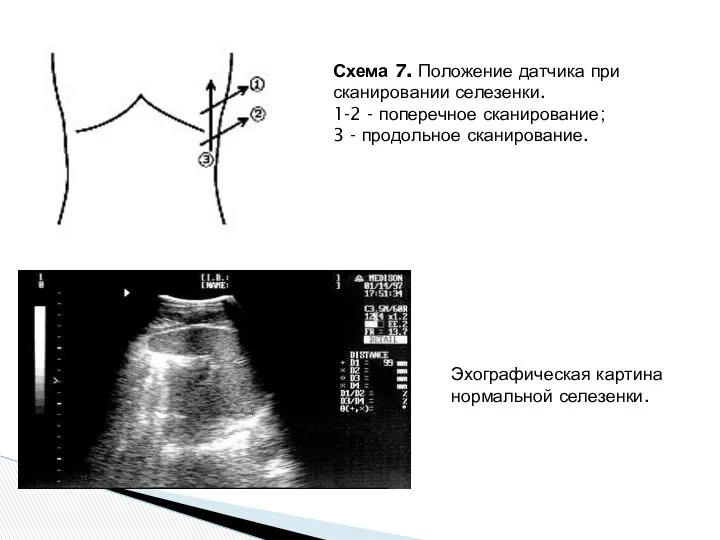 Схема 7. Положение датчика при сканировании селезенки. 1-2 - поперечное