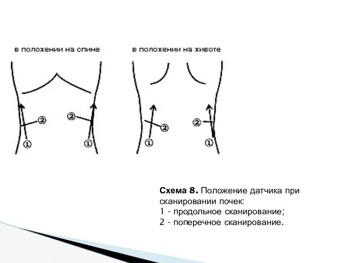 Схема 8. Положение датчика при сканировании почек: 1 - продольное сканирование; 2 - поперечное сканирование.