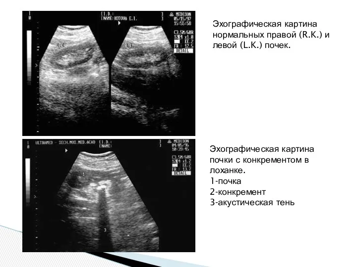 Эхографическая картина почки с конкрементом в лоханке. 1-почка 2-конкремент 3-акустическая