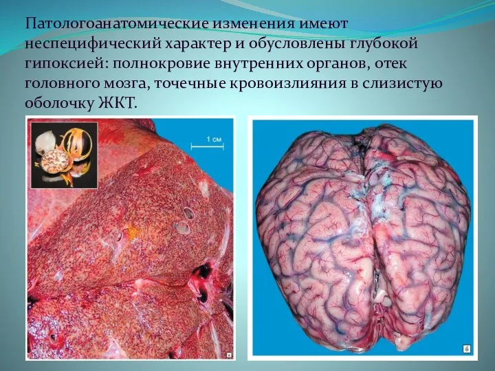 Патологоанатомические изменения имеют неспецифический характер и обусловлены глубокой гипоксией: полнокровие внутренних органов, отек