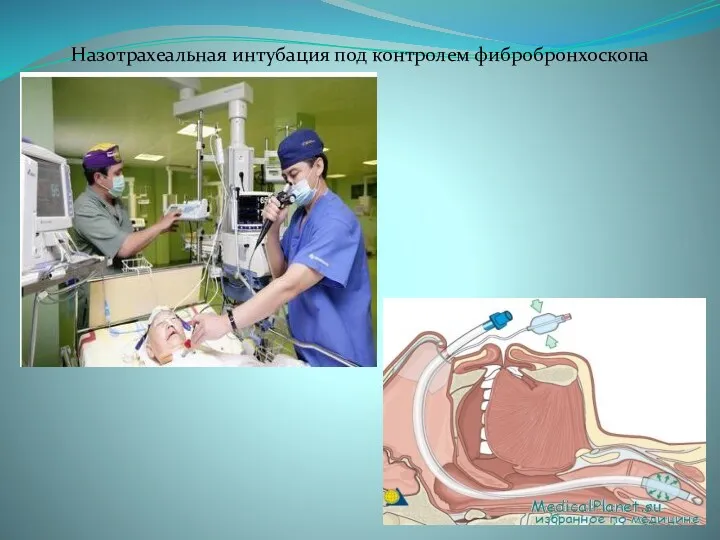 Назотрахеальная интубация под контролем фибробронхоскопа