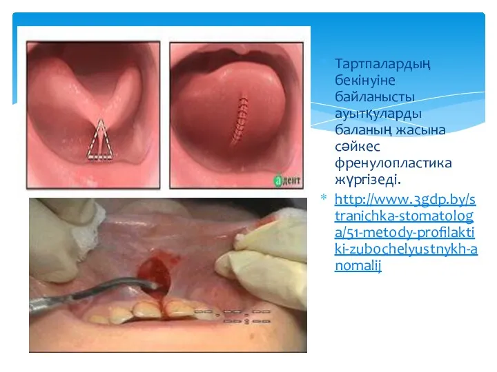 Тартпалардың бекінуіне байланысты ауытқуларды баланың жасына сәйкес френулопластика жүргізеді. http://www.3gdp.by/stranichka-stomatologa/51-metody-profilaktiki-zubochelyustnykh-anomalij