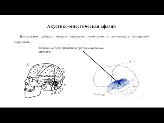 Акустико-мнестическая афазия Поражение локализовано в средней височной извилине Центральным дефектом