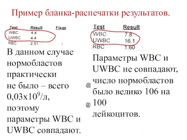 Пример бланка-распечатки результатов. В данном случае нормобластов практически не было