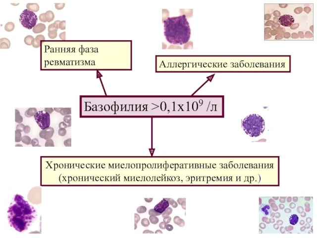 Базофилия >0,1x109 /л Аллергические заболевания Хронические миелопролиферативные заболевания (хронический миелолейкоз, эритремия и др.) Ранняя фаза ревматизма