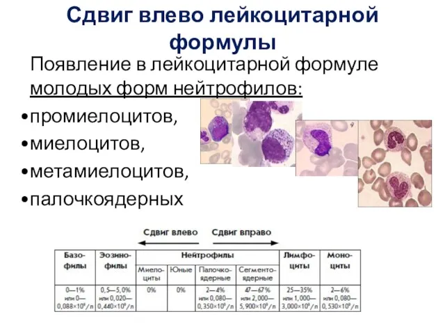 Сдвиг влево лейкоцитарной формулы Появление в лейкоцитарной формуле молодых форм нейтрофилов: промиелоцитов, миелоцитов, метамиелоцитов, палочкоядерных